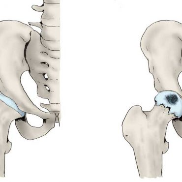 Pelvic surgery day